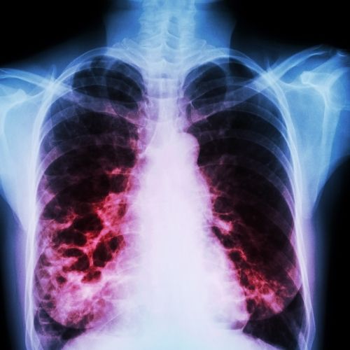 pulmones-bronquiectasia