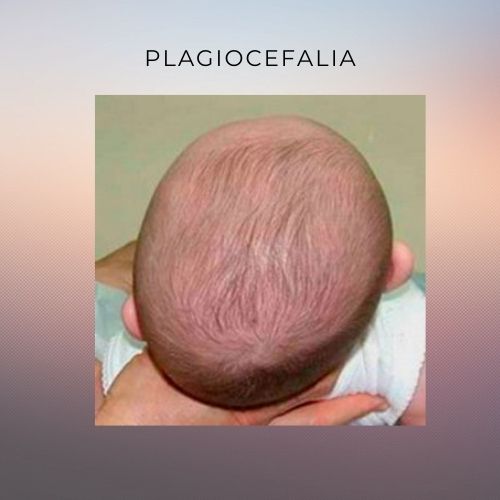 plagiocefalia en bebés con tortícolis congénita